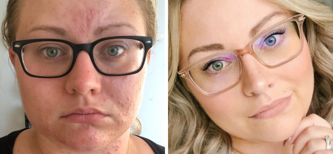 Different acne types and how to treat them